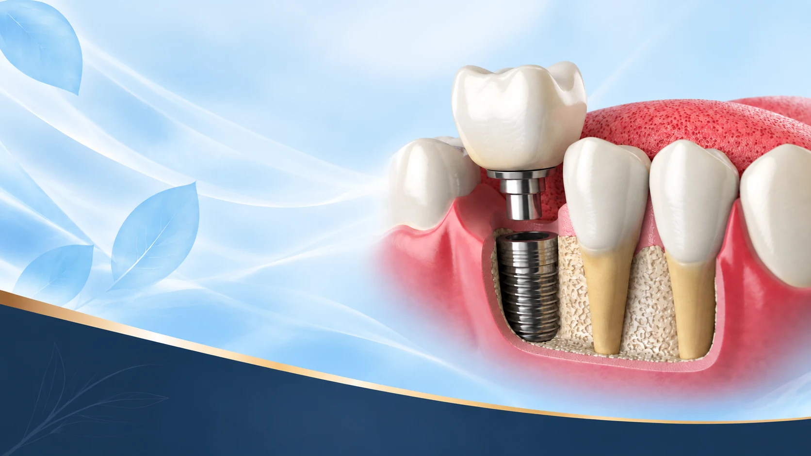 Illustration of a dental implant replacing a missing tooth