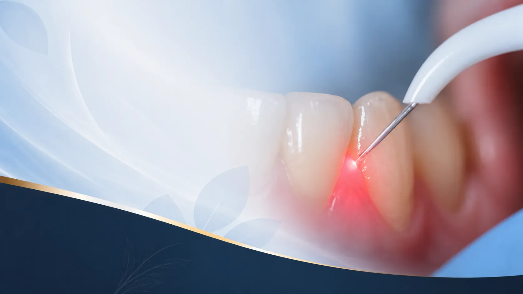 Laser Dentistry